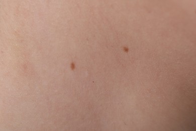 Photo of Woman with moles on her body, closeup