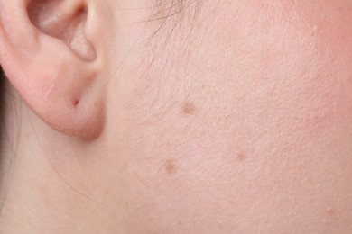 Photo of Woman with moles on her face, closeup