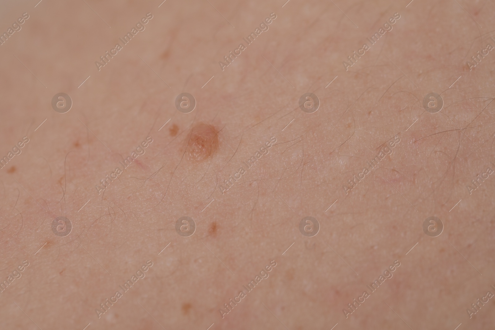 Woman with moles on her body, closeup Photo of Woman with moles on her body, closeup
