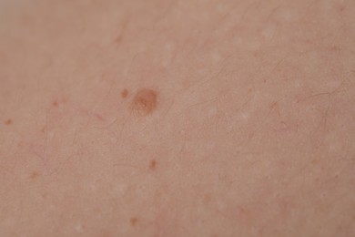 Photo of Woman with moles on her body, closeup