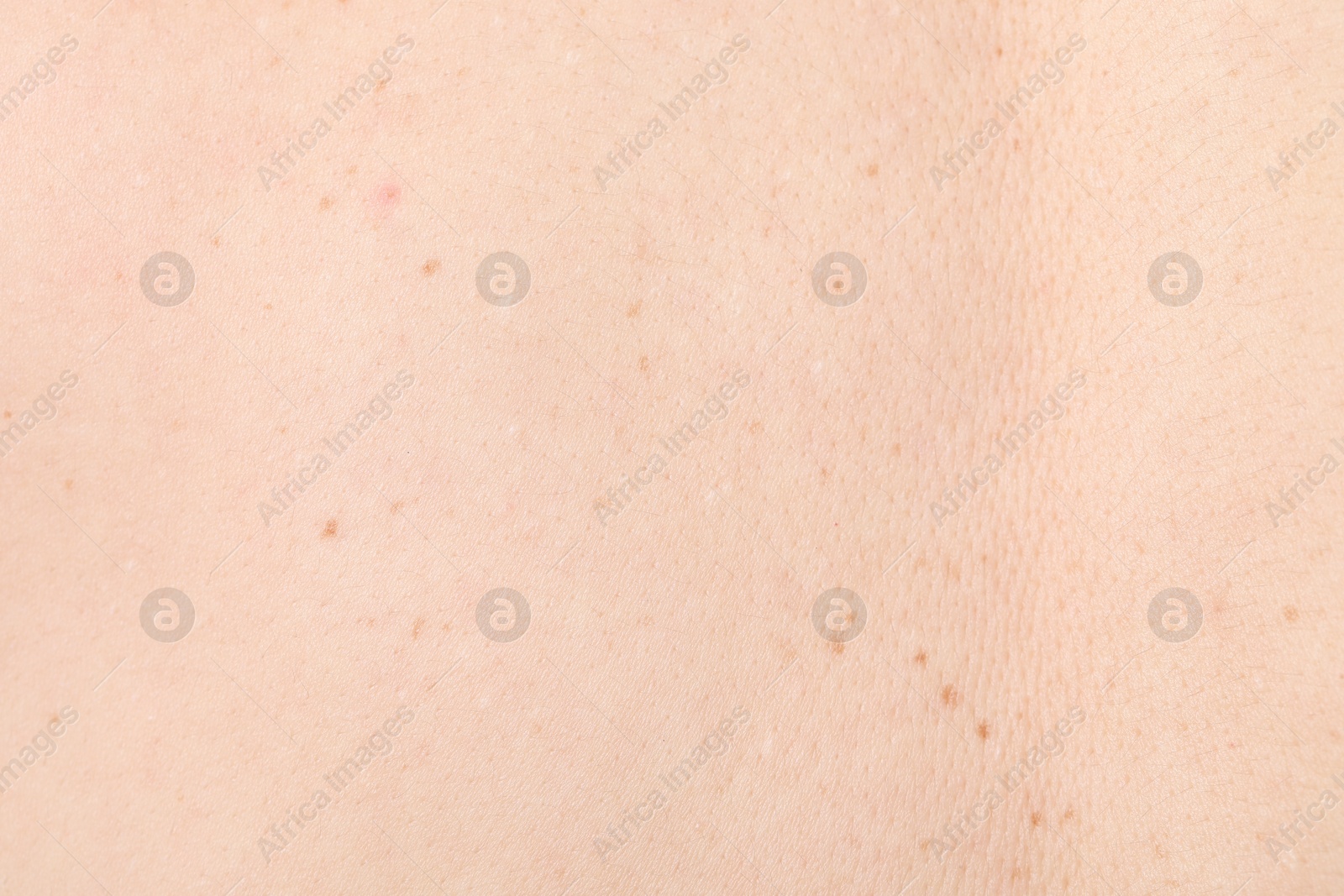 Woman with moles on her body, closeup Photo of Woman with moles on her body, closeup