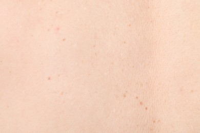 Photo of Woman with moles on her body, closeup
