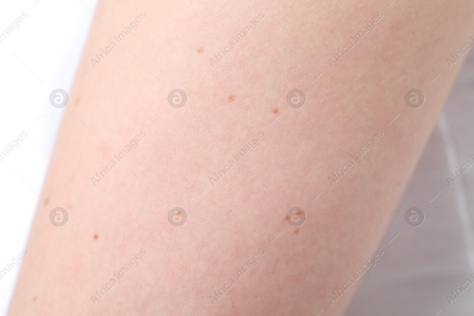 Woman with moles on her body against white background, closeup Photo of Woman with moles on her body against white background, closeup