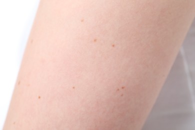 Photo of Woman with moles on her body against white background, closeup