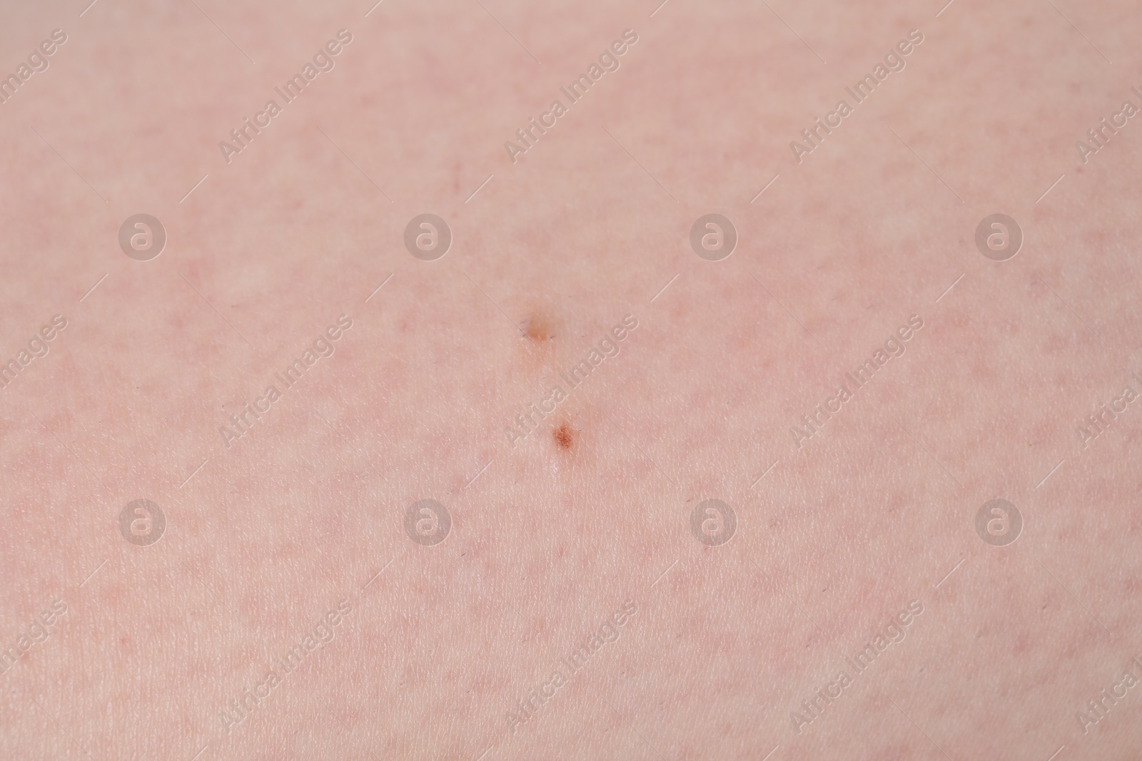 Woman with moles on her body, closeup Photo of Woman with moles on her body, closeup