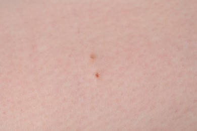 Photo of Woman with moles on her body, closeup