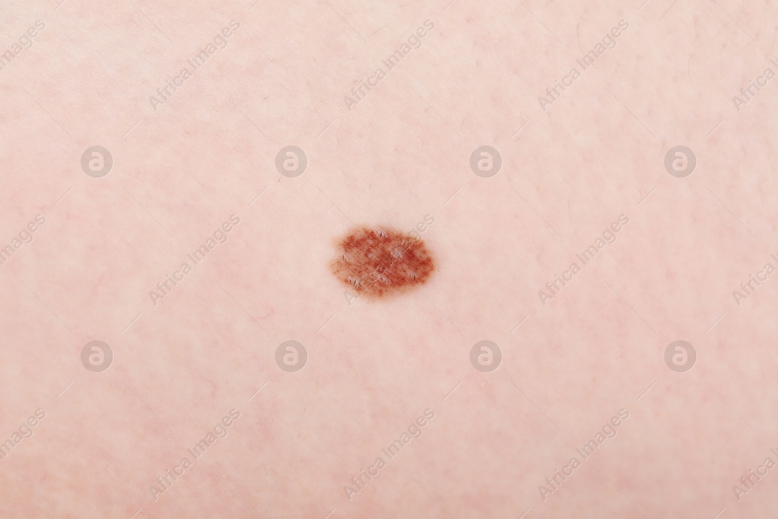 Woman with mole on her body, closeup Photo of Woman with mole on her body, closeup