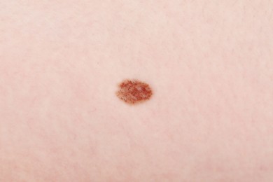 Photo of Woman with mole on her body, closeup