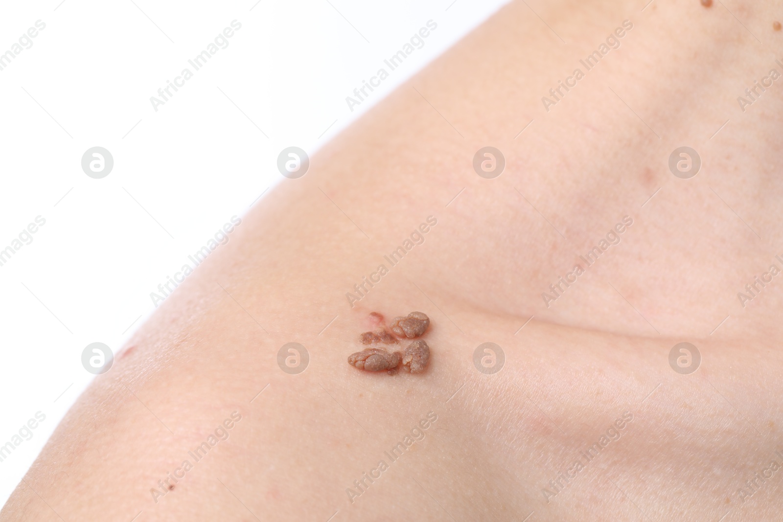 Woman with moles on her body against white background, closeup Photo of Woman with moles on her body against white background, closeup