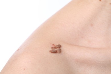 Photo of Woman with moles on her body against white background, closeup