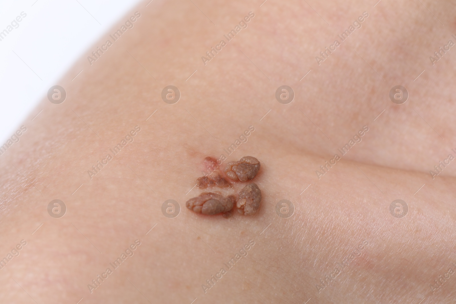 Woman with moles on her body against white background, closeup Photo of Woman with moles on her body against white background, closeup