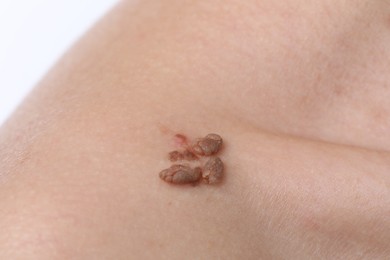 Photo of Woman with moles on her body against white background, closeup