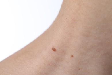 Photo of Woman with moles on her body against white background, closeup