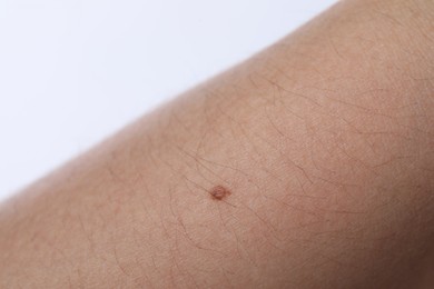 Photo of Woman with mole on her body against white background, closeup