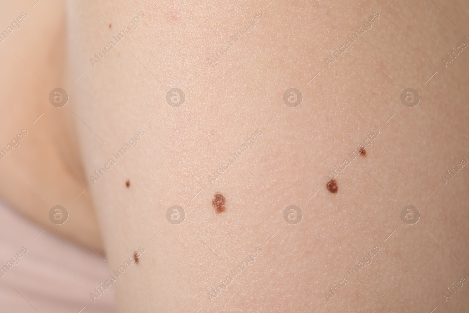 Woman with moles on her body, closeup Photo of Woman with moles on her body, closeup