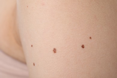 Photo of Woman with moles on her body, closeup