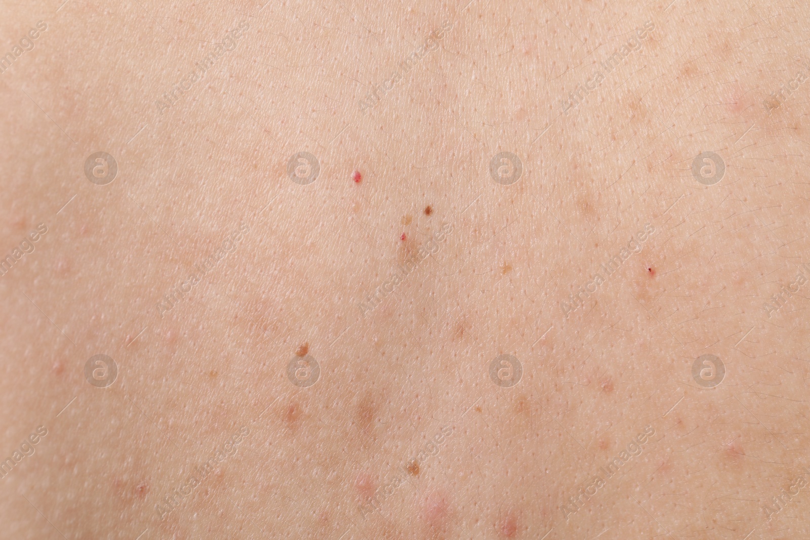 Woman with moles on her body, closeup Photo of Woman with moles on her body, closeup