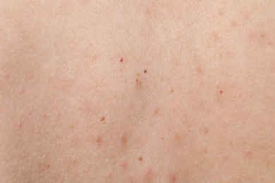 Photo of Woman with moles on her body, closeup