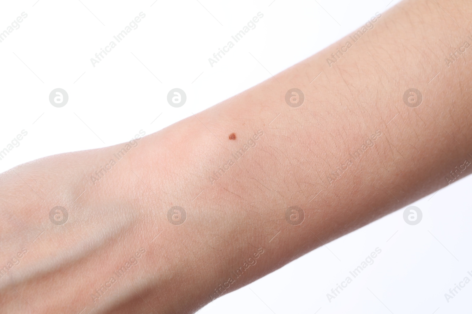 Photo of Woman with mole on her body against white background, closeup