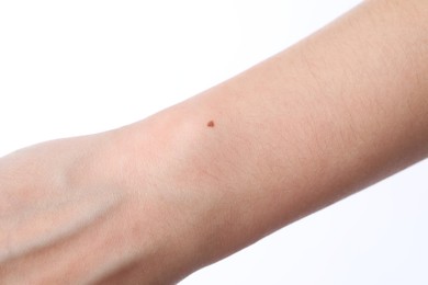 Photo of Woman with mole on her body against white background, closeup