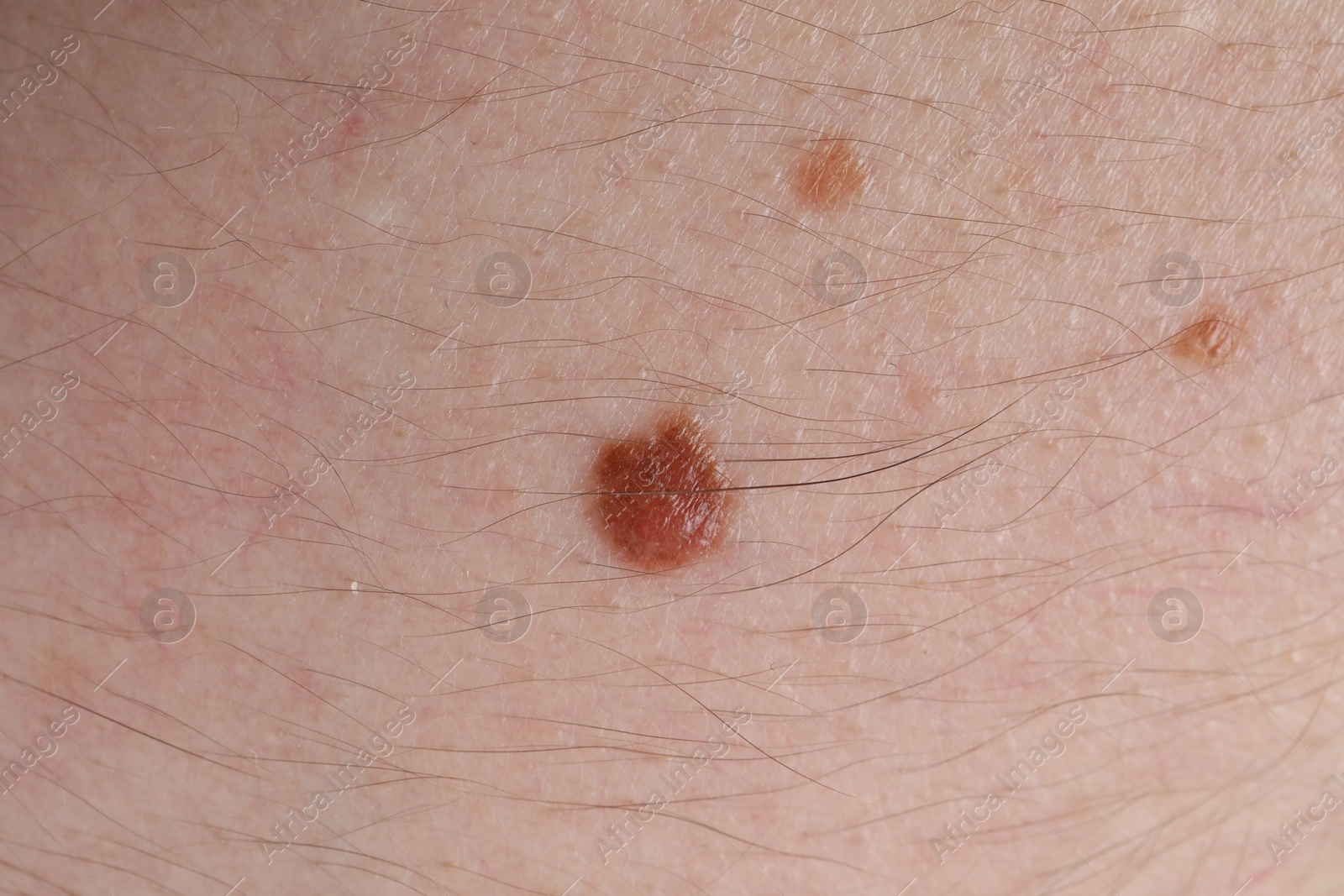 Photo of Woman with moles on her body, closeup