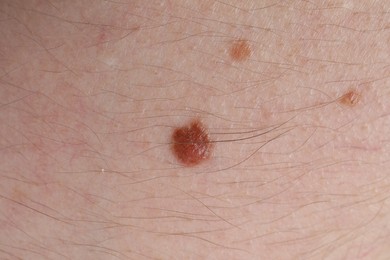 Photo of Woman with moles on her body, closeup