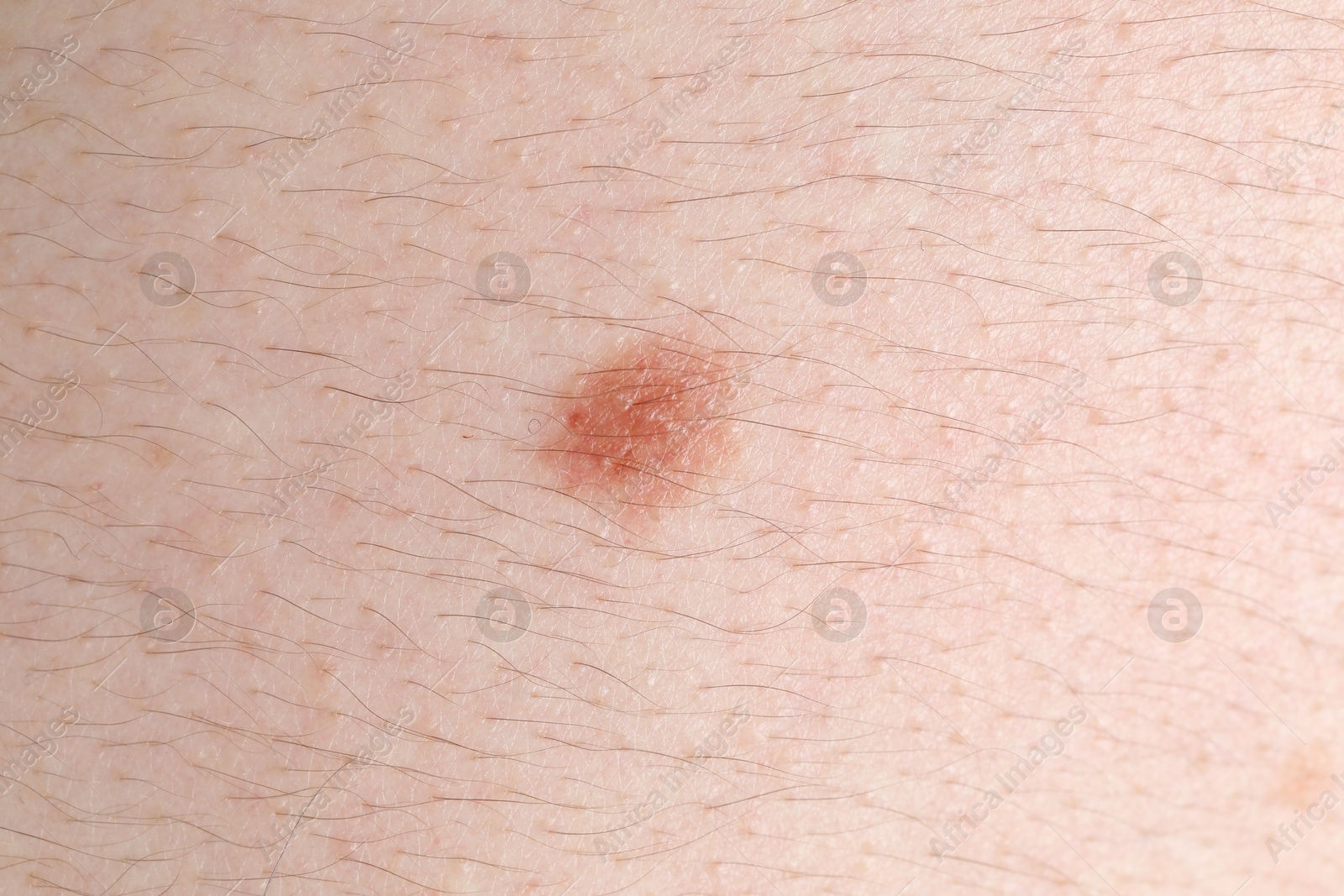 Woman with mole on her body, closeup Photo of Woman with mole on her body, closeup