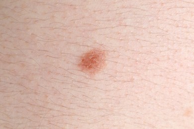 Photo of Woman with mole on her body, closeup