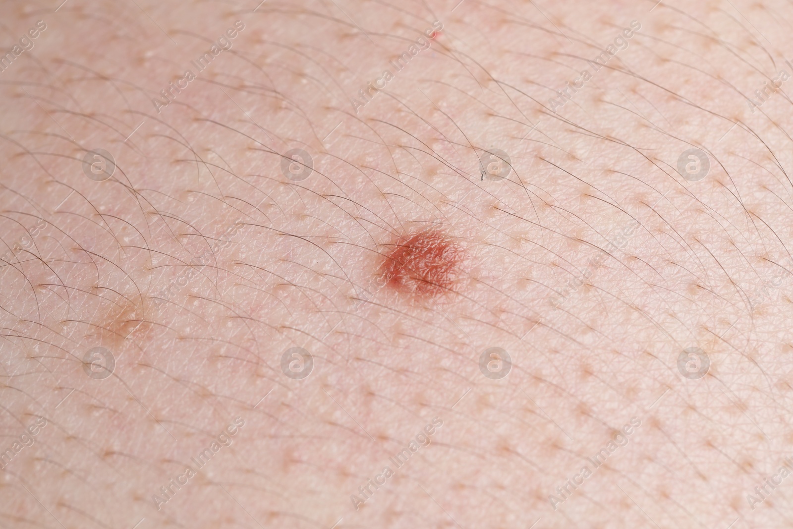 Woman with moles on her body, closeup Photo of Woman with moles on her body, closeup