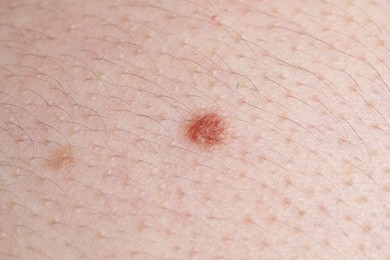 Photo of Woman with moles on her body, closeup