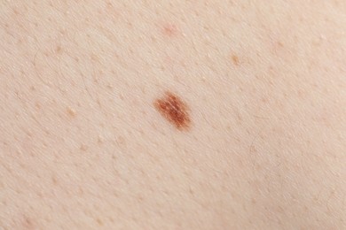 Photo of Woman with moles on her body, closeup