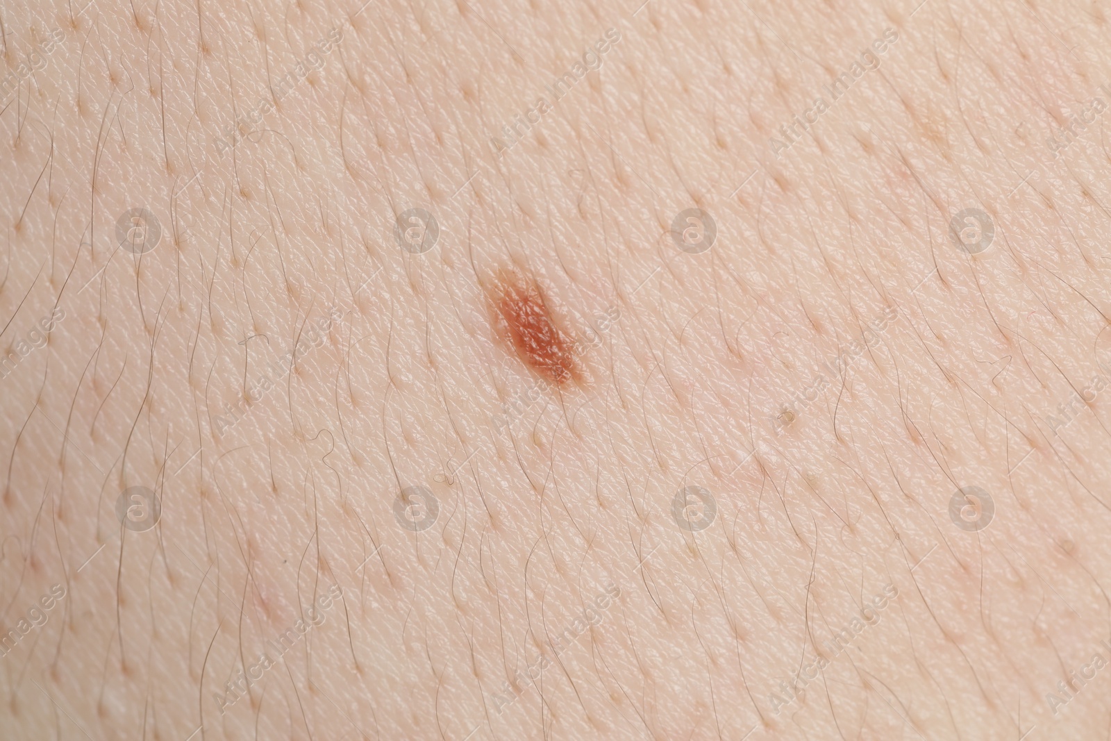 Woman with mole on her body, closeup Photo of Woman with mole on her body, closeup