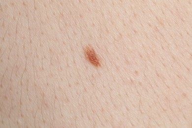 Photo of Woman with mole on her body, closeup