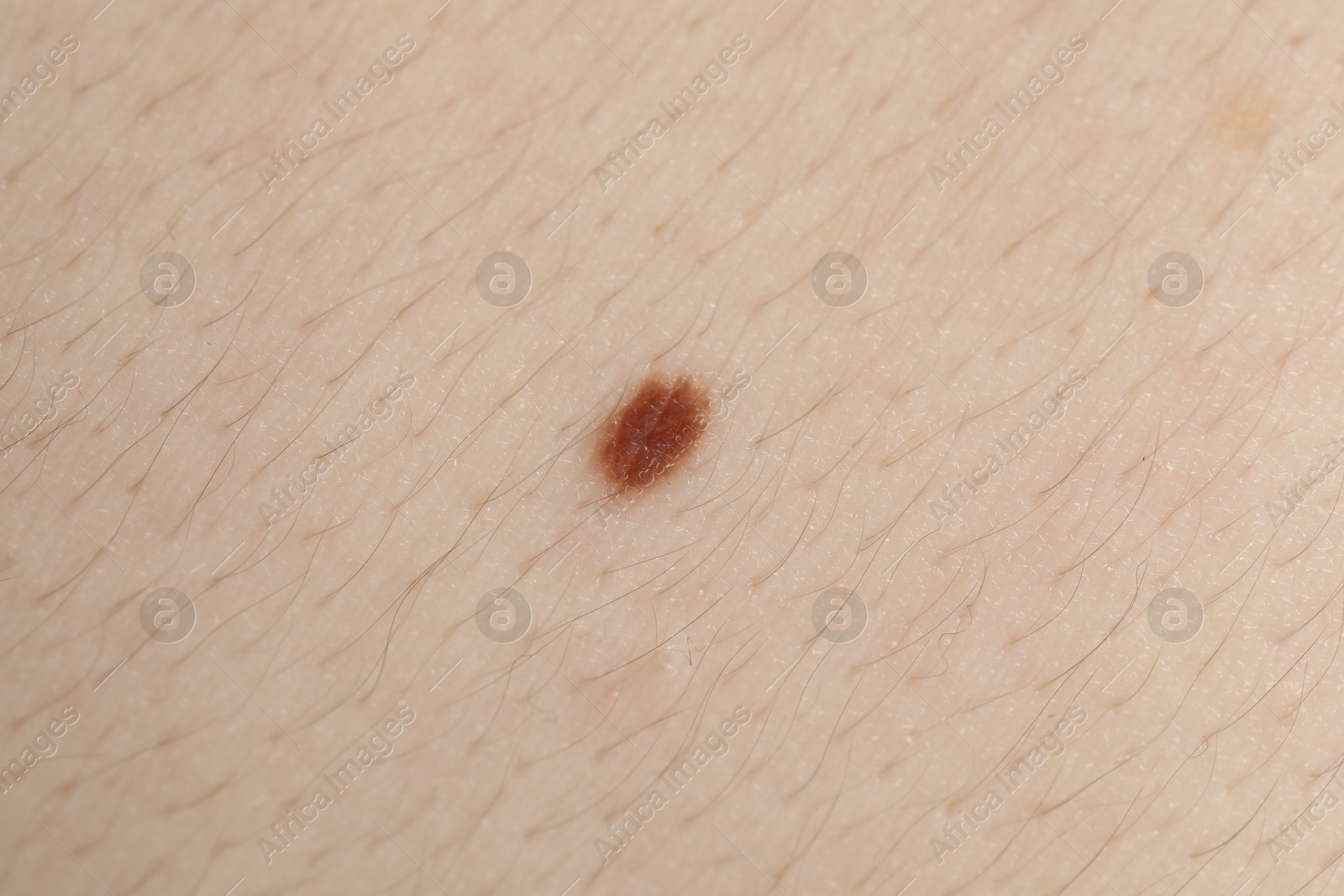 Woman with mole on her body, closeup Photo of Woman with mole on her body, closeup