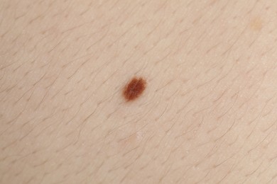 Photo of Woman with mole on her body, closeup