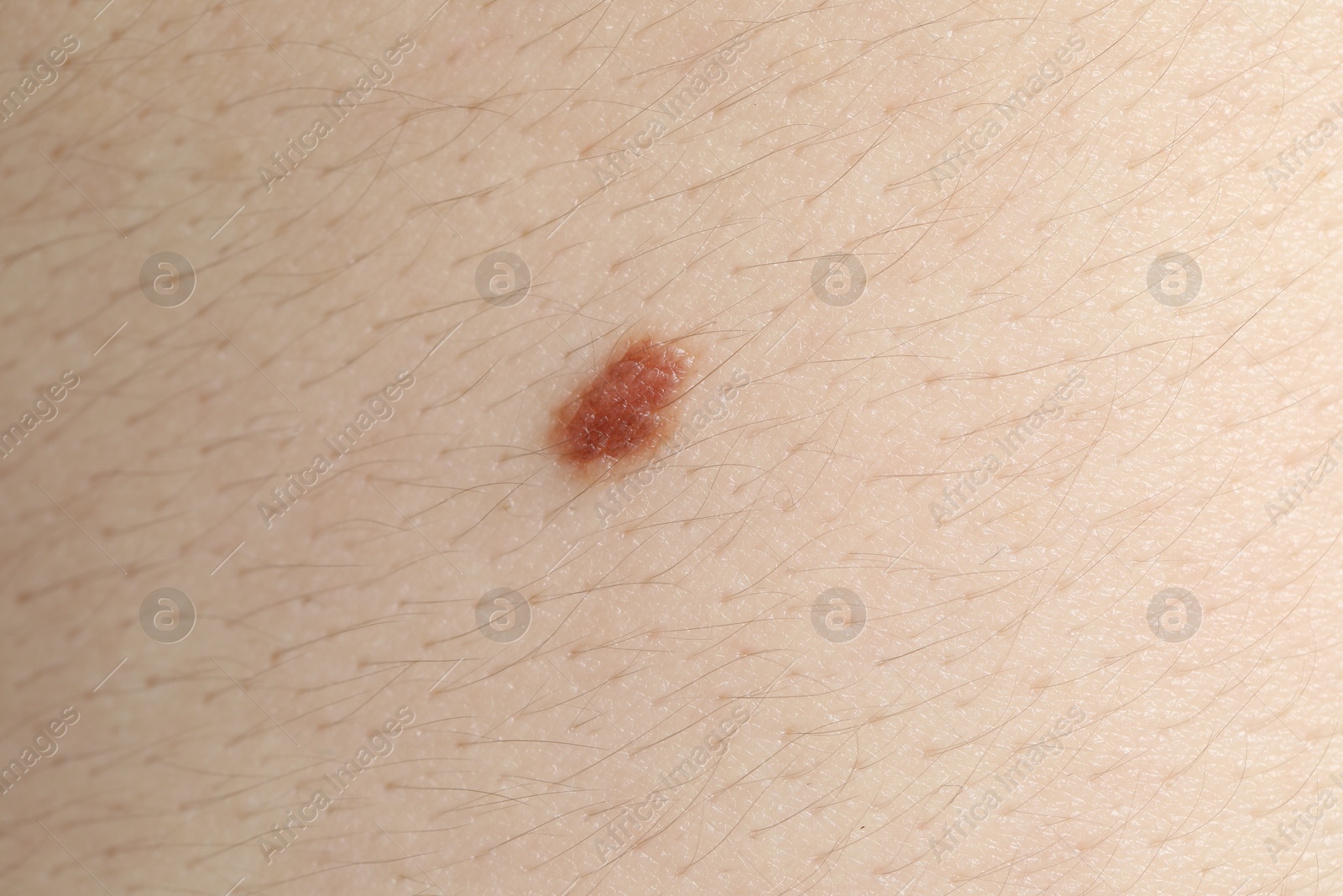 Woman with mole on her body, closeup Photo of Woman with mole on her body, closeup