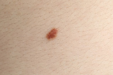 Photo of Woman with mole on her body, closeup