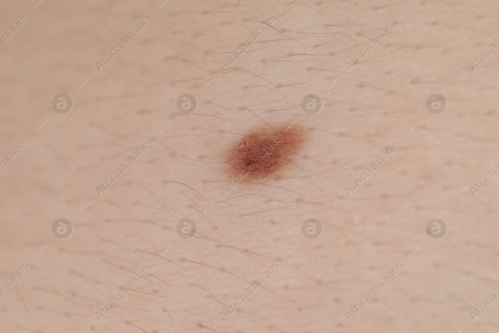 Woman with mole on her body, closeup Photo of Woman with mole on her body, closeup