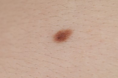 Photo of Woman with mole on her body, closeup