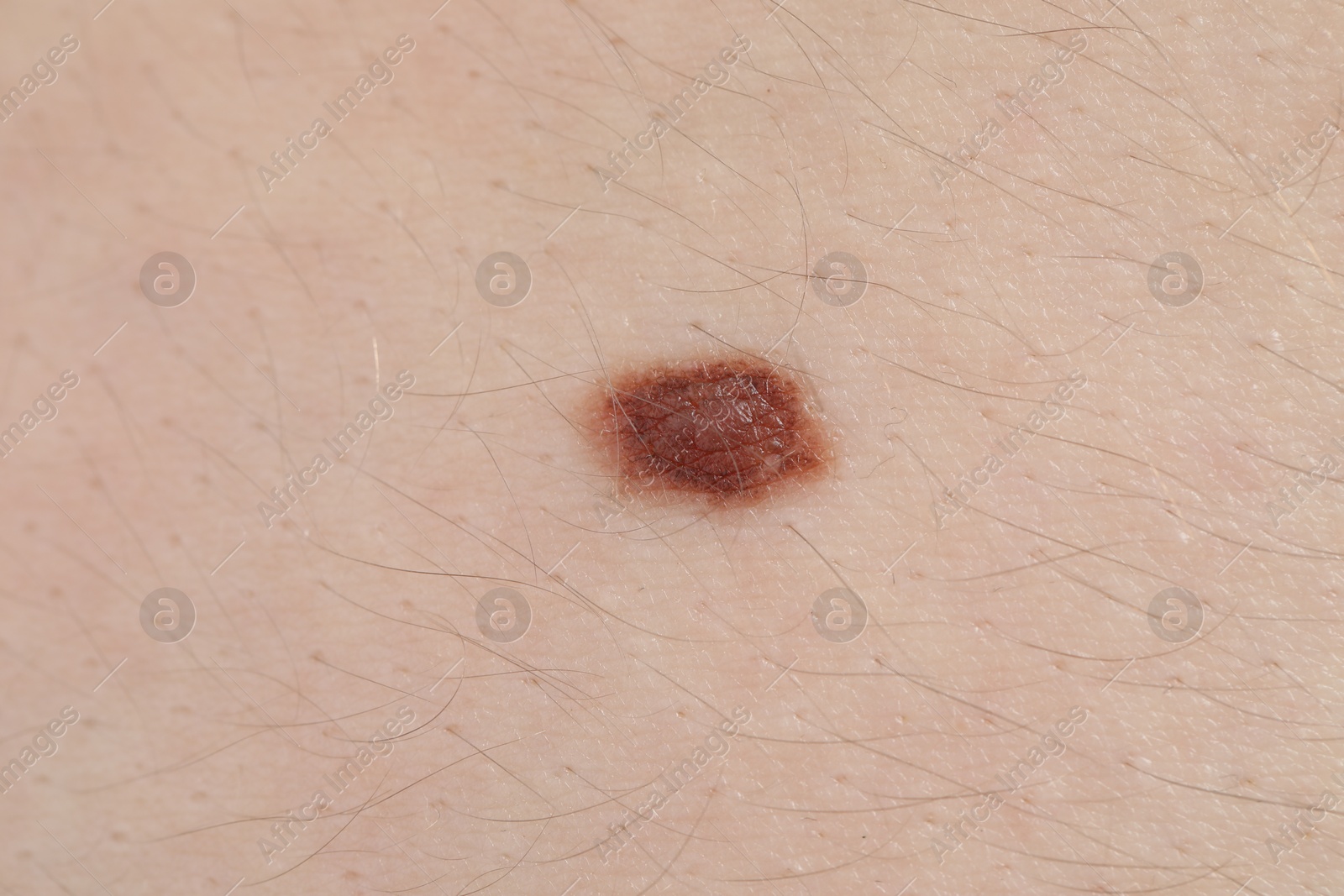 Woman with mole on her body, closeup Photo of Woman with mole on her body, closeup