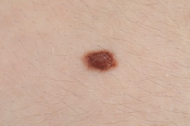 Photo of Woman with mole on her body, closeup