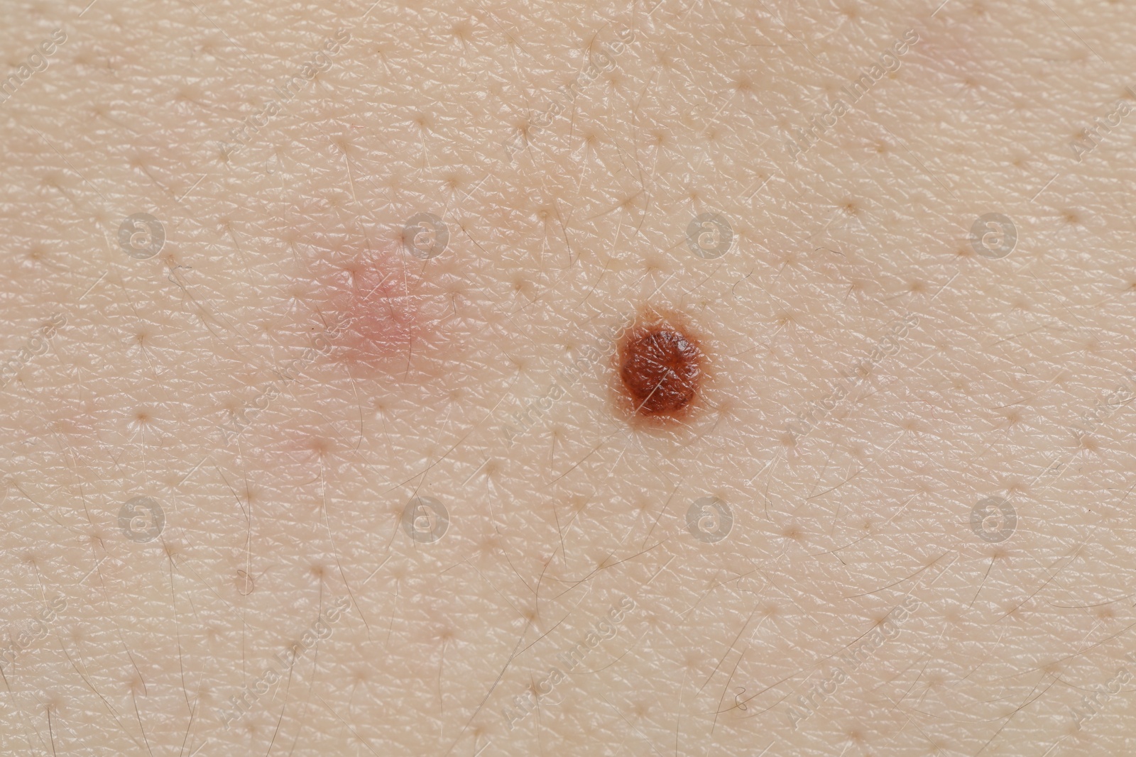 Woman with moles on her body, closeup Photo of Woman with moles on her body, closeup