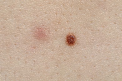 Photo of Woman with moles on her body, closeup