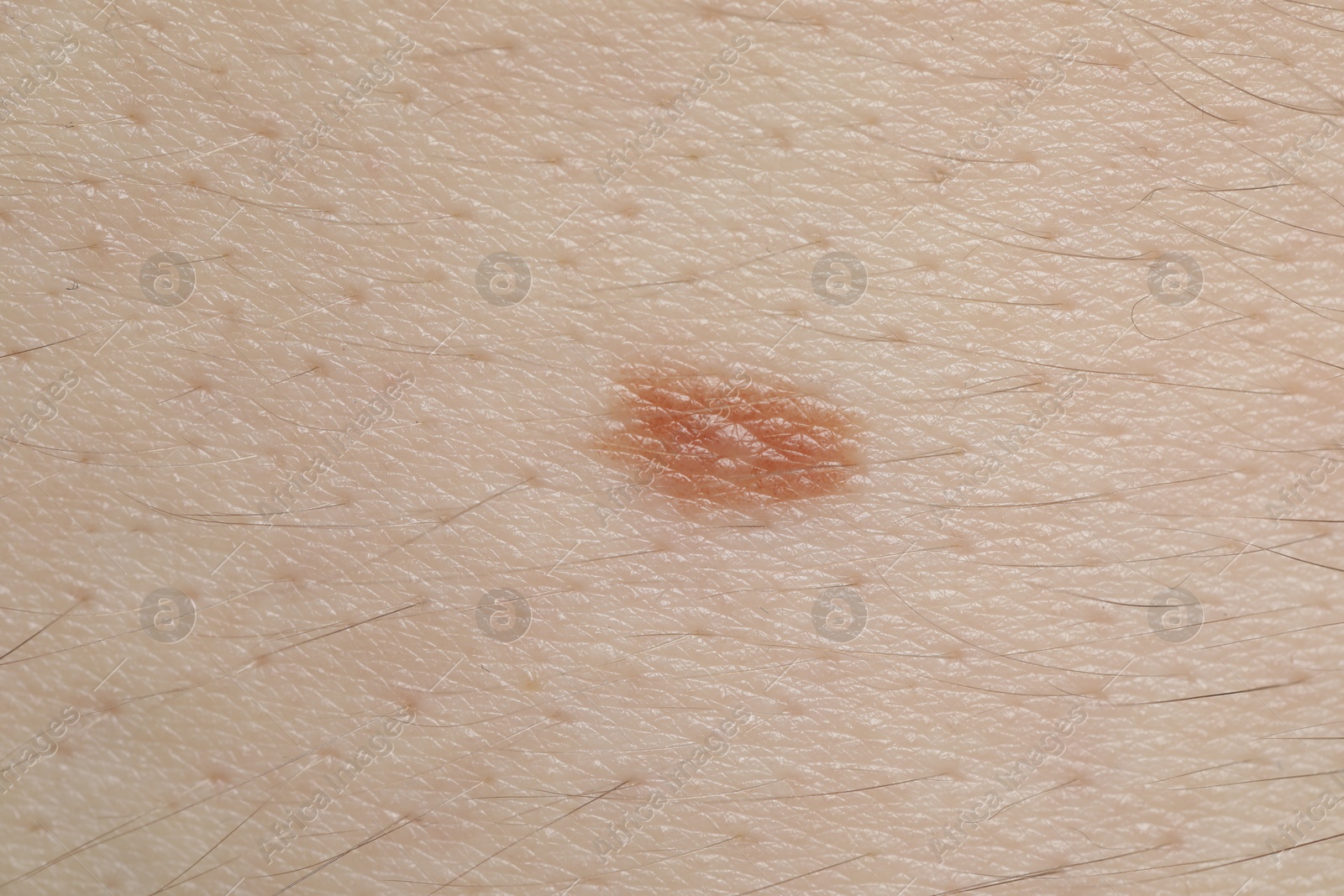 Woman with mole on her body, closeup Photo of Woman with mole on her body, closeup