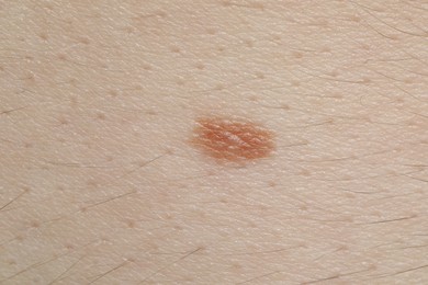 Photo of Woman with mole on her body, closeup