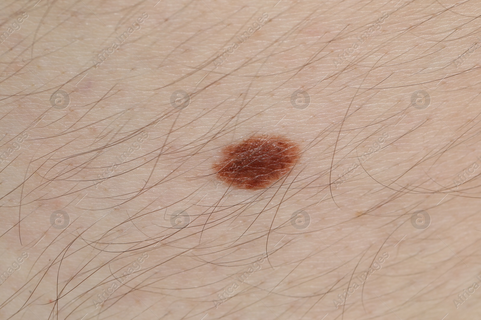 Woman with mole on her body, closeup Photo of Woman with mole on her body, closeup