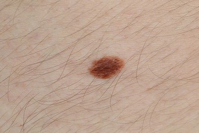 Photo of Woman with mole on her body, closeup