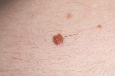 Photo of Woman with moles on her body, closeup