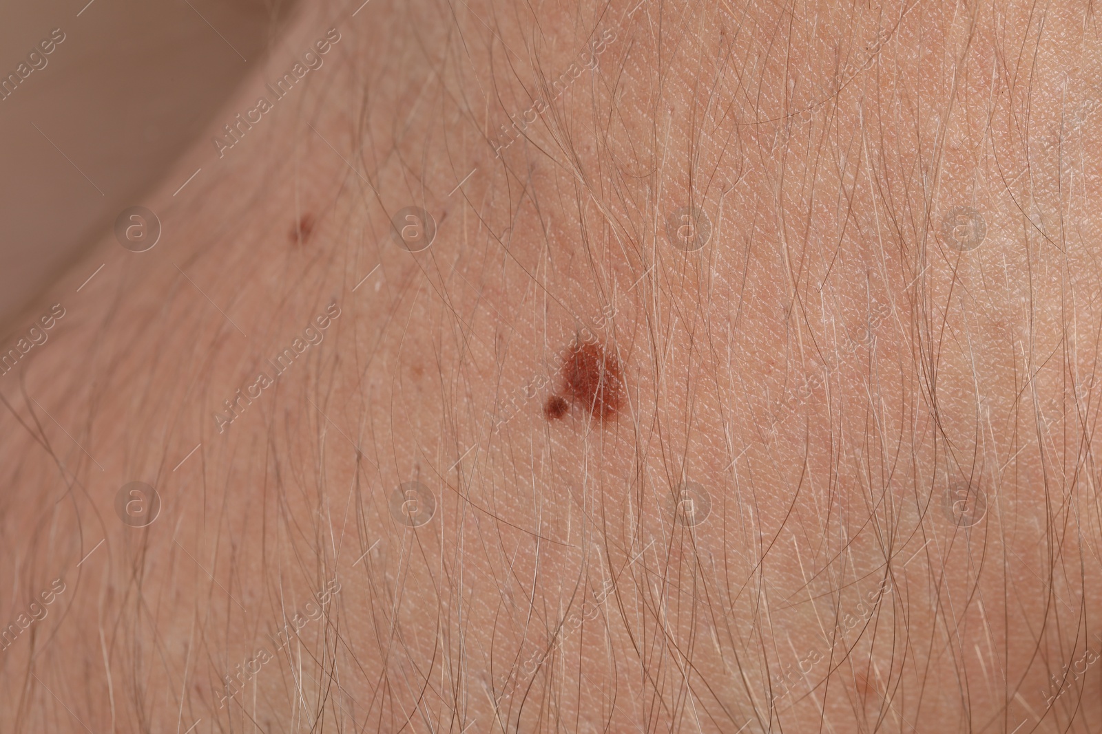 Woman with moles on her body, closeup Photo of Woman with moles on her body, closeup