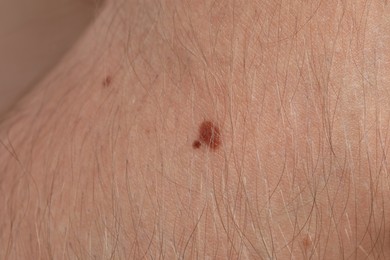 Photo of Woman with moles on her body, closeup